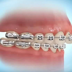 Orthodontie ado et adulte : Corriger l'alignement dents définitives - Dr  Gilbert