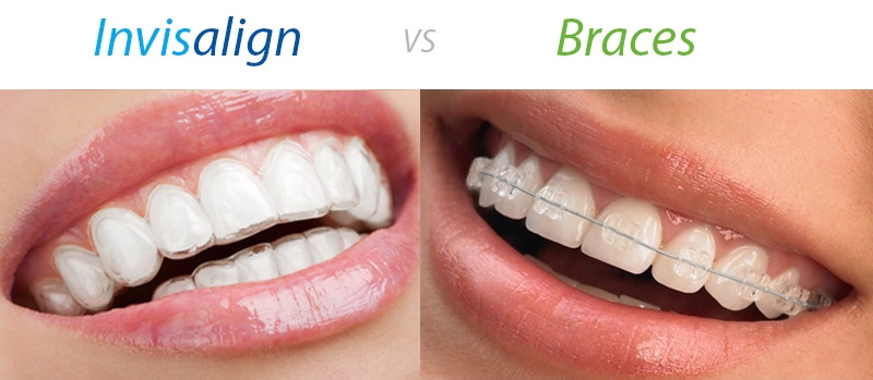 Le point sur les différentes techniques orthodontiques (fixes versus  aligneurs) : indications chez l'adulte et incidences parodontales –  L'Information Dentaire
