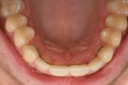 contention orthodontie