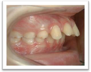 Problèmes mastication