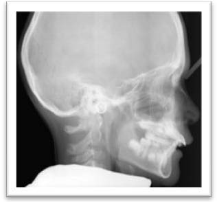 Problèmes incision et mastication
