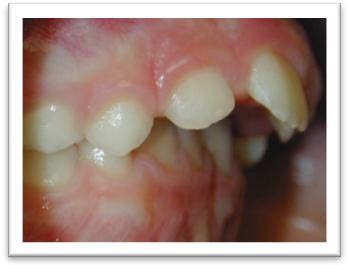 Problèmes incision